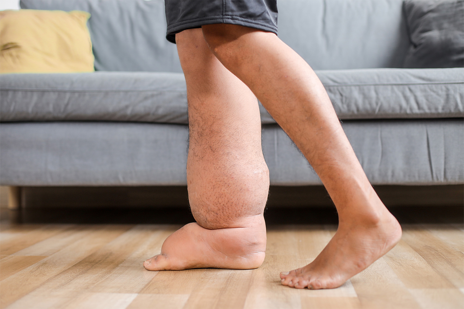 Explore how lymphedema and varicose veins are connected, what makes them different, shared risk factors, and when to seek expert vein specialist care.