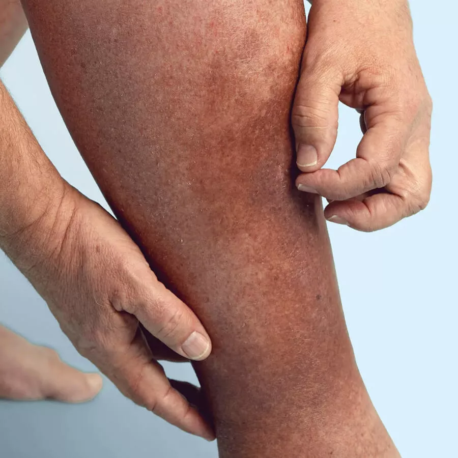President Trump’s chronic venous insufficiency (CVI) diagnosis explained: symptoms, causes, and modern treatments for this common, treatable vein disease.