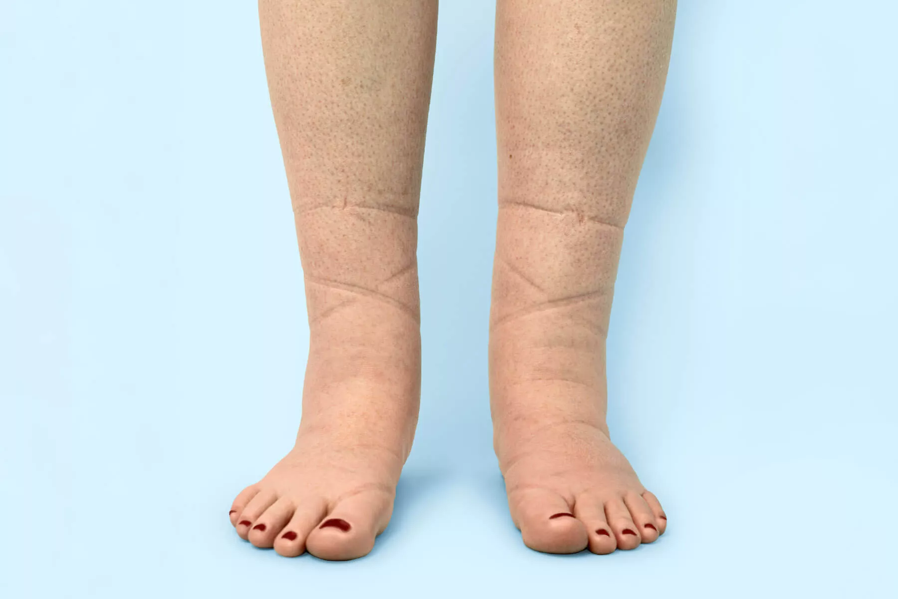 edema